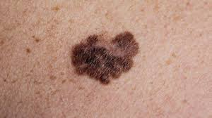 Melanomul, inamicul invizibil de pe plajă. Tinerii sunt cei mai afectați