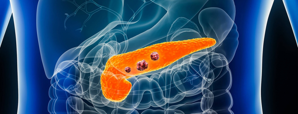 Un vaccin experimental ar putea salva bolnavii de cancer pancreatic