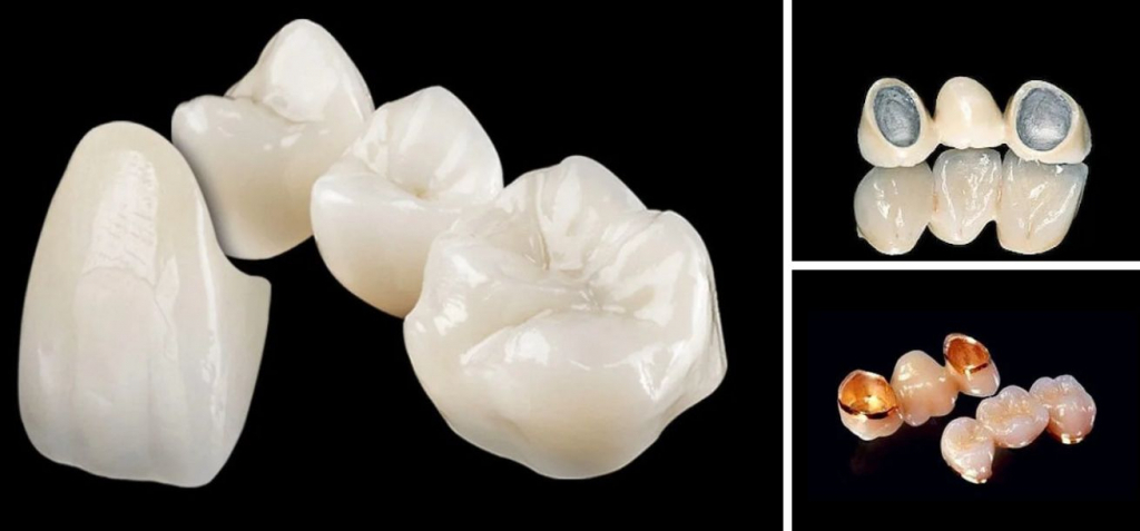  Care este diferenta dintre lucrarile dentare metalo ceramice si cele din zirconiu?