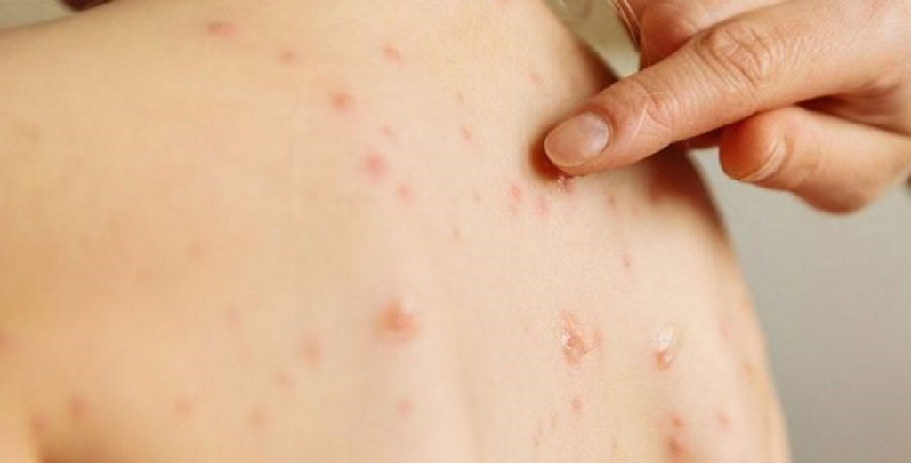 Campanie de informare privind vaccinarea împotriva rujeolei la Vaslui