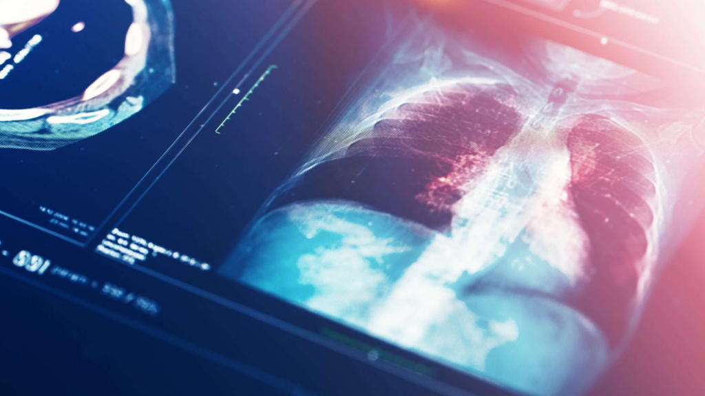 Pneumonia,  cea mai mare afecţiune cauzatoare de moarte în rândul adulţilor şi în cel al copiilor