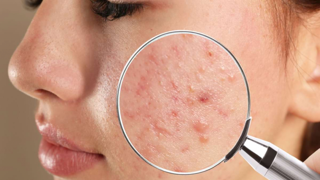 Vaccinul anti-acnee, aproape de realitate. Ce promite și când ar putea apărea