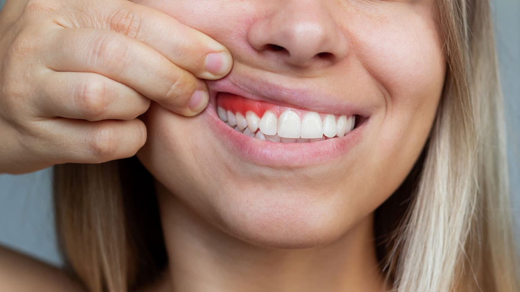 Semnal de alarmă! Peste 60% dintre români suferă de afecțiuni gingivale
