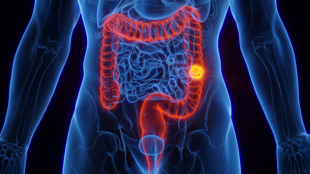 Cancerul colorectal ucide anual peste 7.000 de români