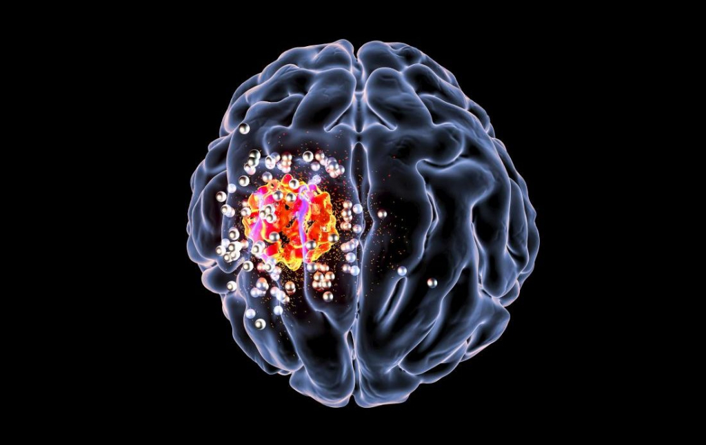 Mutațiile genetice din tumorile cerebrale canceroase, depistate cu ajutorul IA