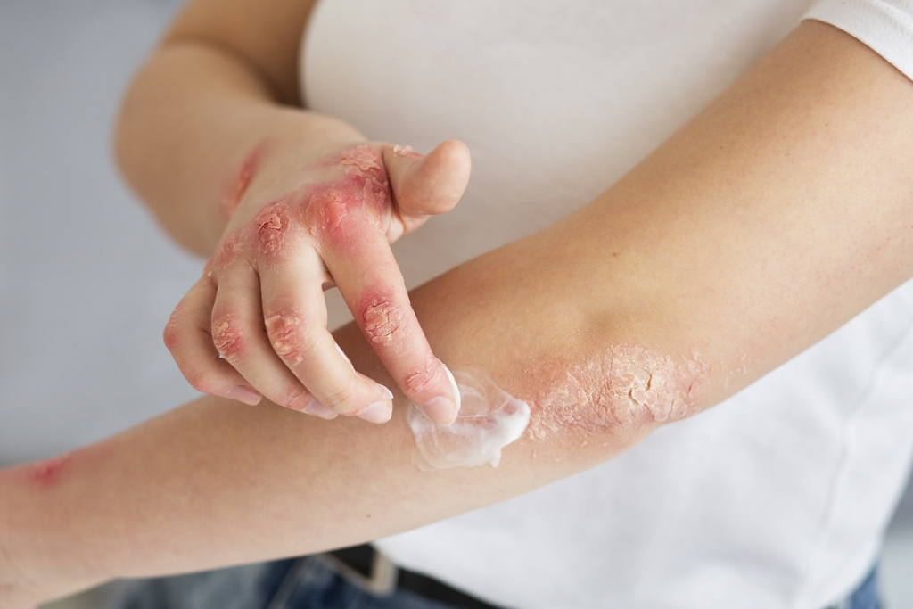 Dermatita Alergică: Cum recunoști și tratezi iritațiile pielii