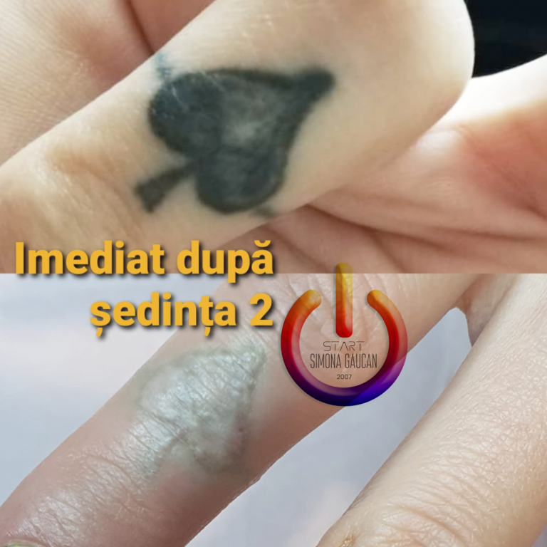  Cum pot fi șterse tatuajele vechi